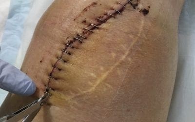 Total Knee Replacement – Left Knee – Week 1